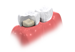 Vollkeramik_Krone