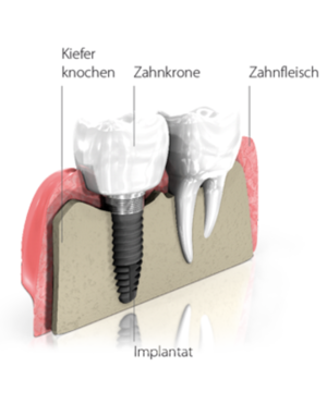 csm_Implantat_7e44173e67